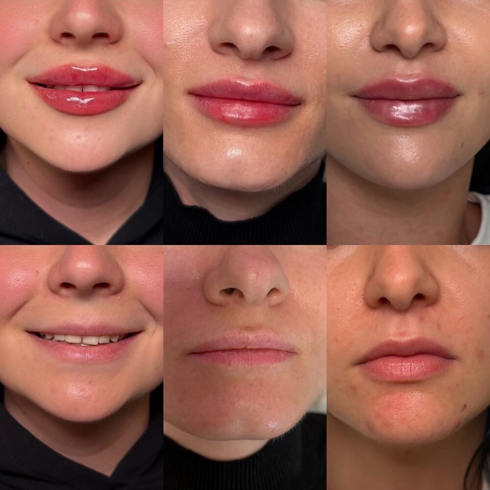 Efekt zabiegu before / after — LOOK BETTER Kinga Rusin