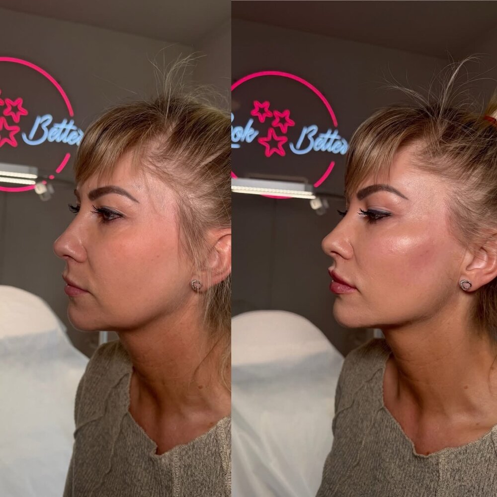 Efekt zabiegu medycyny estetycznej before / after