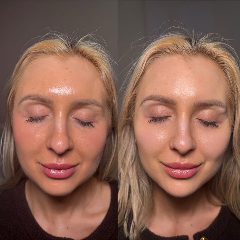Efekt zabiegu before / after — gabinet Kinga Rusin