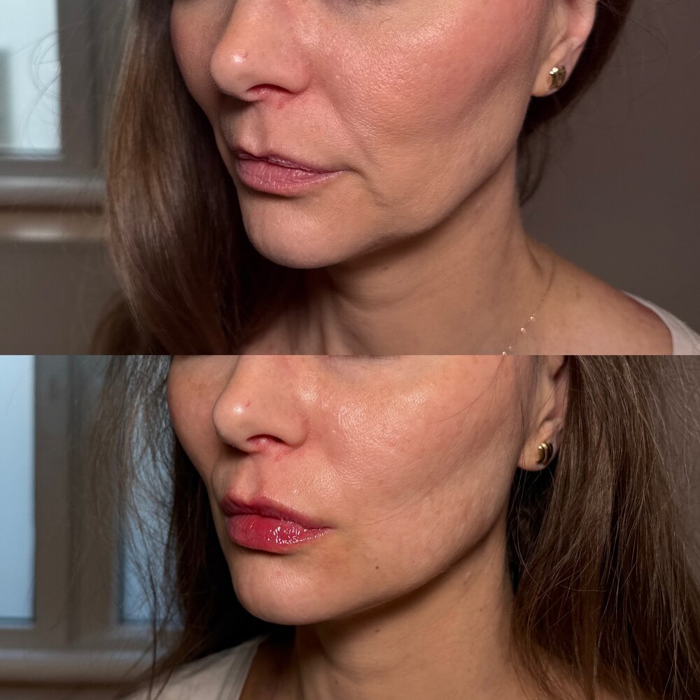 Modelowanie owalu twarzy — efekt before / after, LOOK BETTER Bielsko-Biała